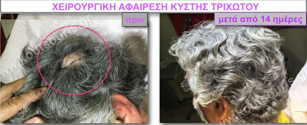 Λίπος μαύρο τριχωτό μουνί εικόνες