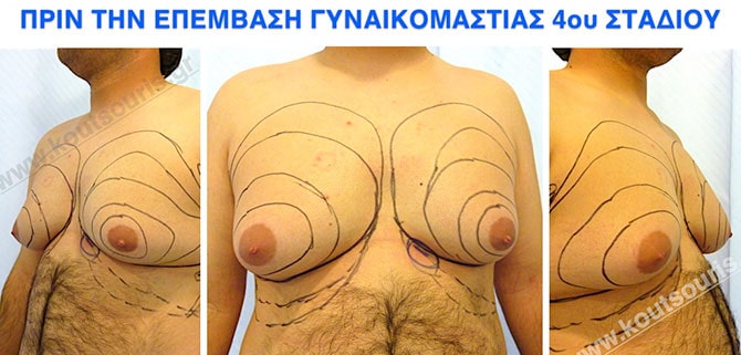 gynecomastia-57 gynecomastia 57.jpg