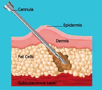 3d lipoanarrofisi 007.jpg