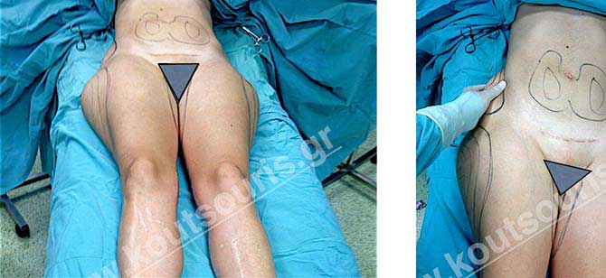3d lipoanarrofisi 014.jpg
