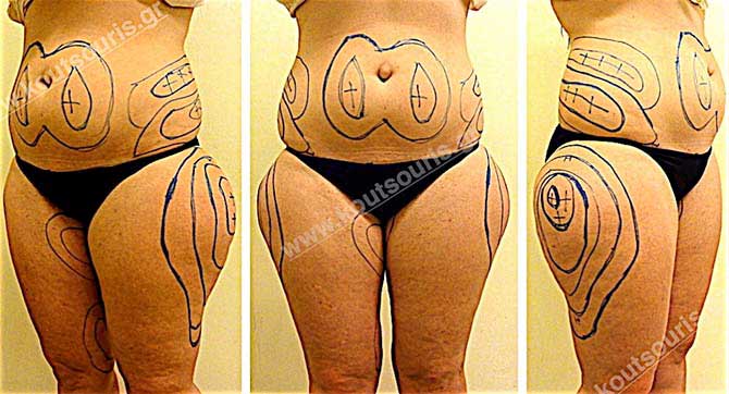 3d lipoanarrofisi 020.jpg