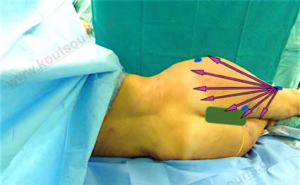 3d lipoanarrofisi 025.jpg
