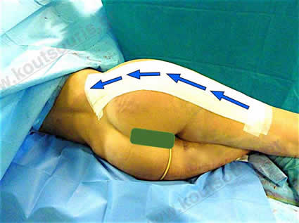 3d lipoanarrofisi 032.jpg