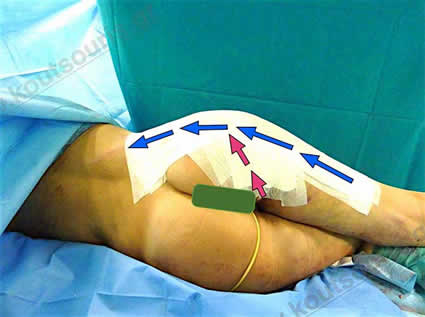 3d lipoanarrofisi 033.jpg