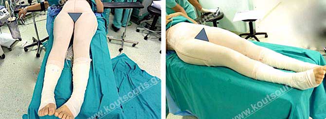 3d lipoanarrofisi 035.jpg