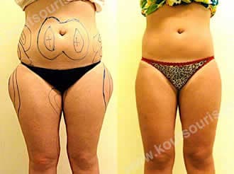 3d lipoanarrofisi 037.jpg
