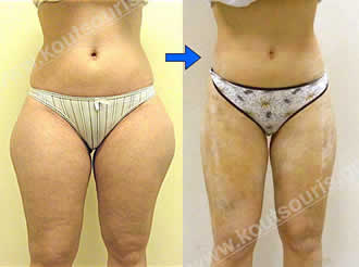 3d lipoanarrofisi 048.jpg
