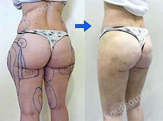 3d lipoanarrofisi 050.jpg
