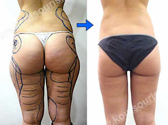 3d lipoanarrofisi 055.jpg