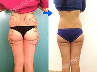 3d lipoanarrofisi 069.jpg