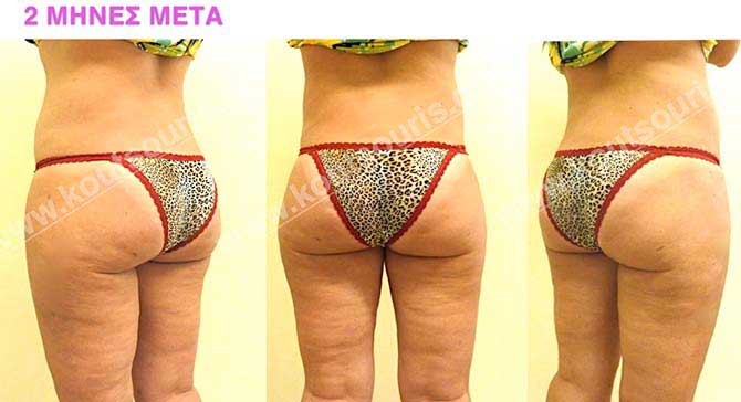 3d-lipoanarrofisi-077 3d lipoanarrofisi 077.jpg