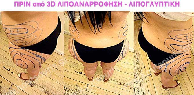 3d-lipoanarrofisi-078 3d lipoanarrofisi 078.jpg