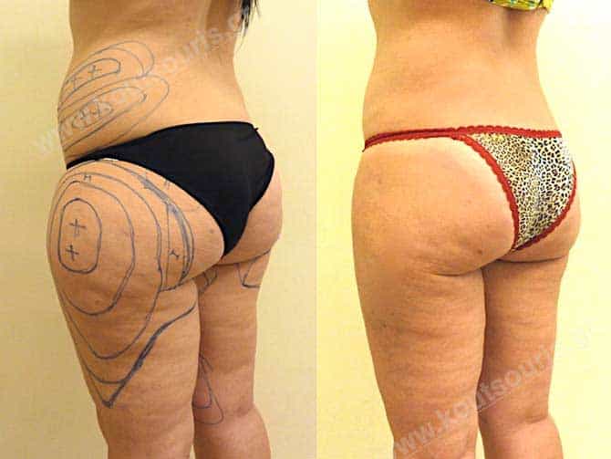 3d lipoanarrofisi 082.jpg