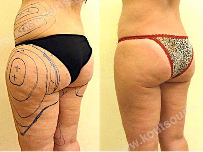 3d lipoanarrofisi 085.jpg
