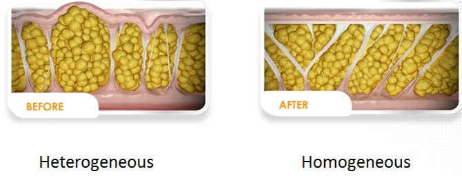 cellulite-26 cellulite 26.jpg