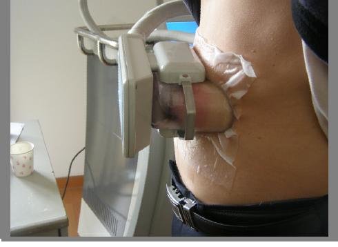 Zeltiq Coolsculpting System Cryolipolysis.jpg