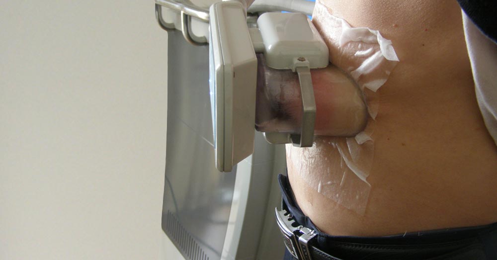 Zeltiq Coolsculpting System Cryolipolysis