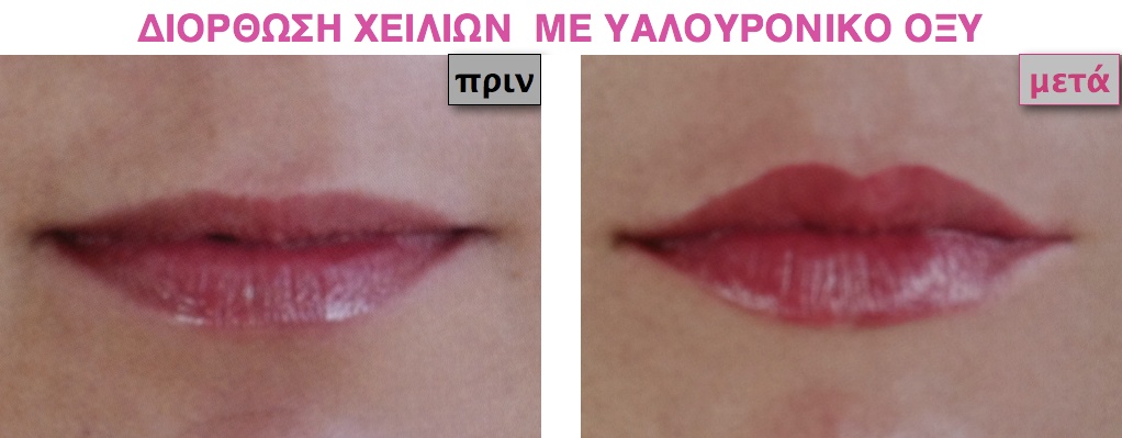 YALOURONIC ACID ΥΑΛΟΥΡΟΝΙΚΟ ΟΞΥ.030.jpg