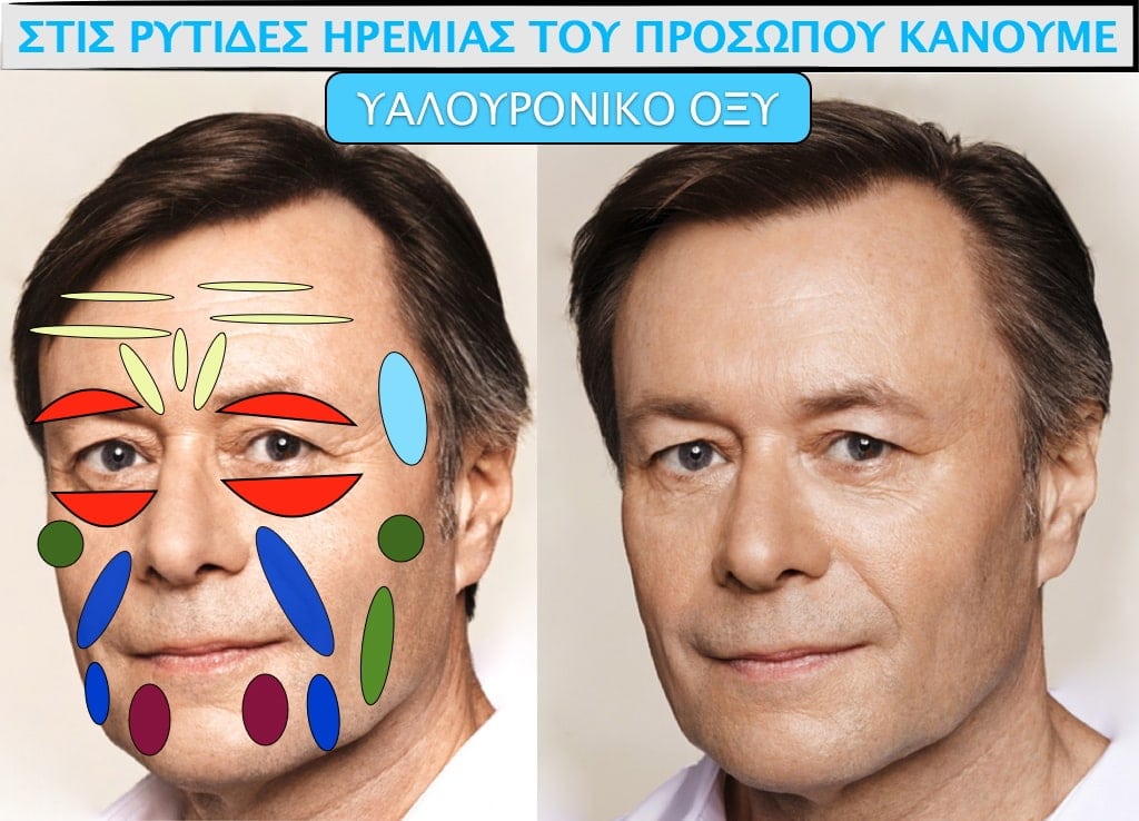 PLASTIKH XORIS NYSTERI GIA ANTRES.008.jpg