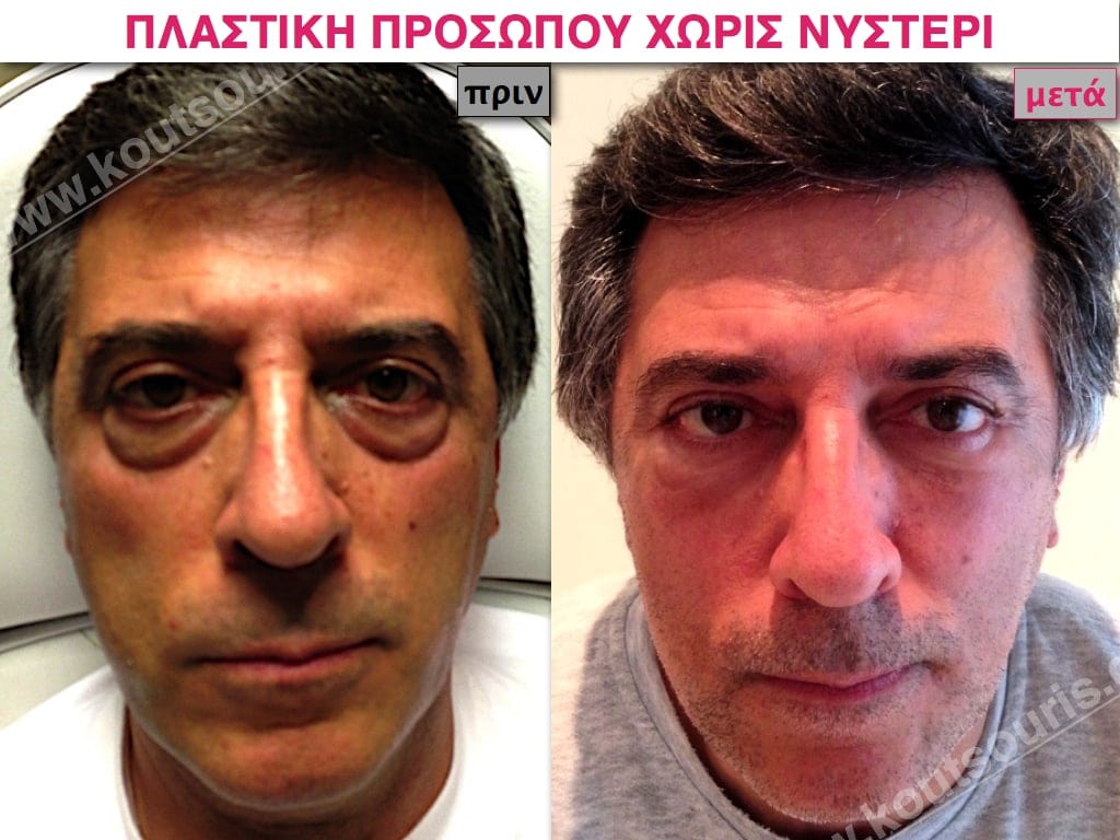 PLASTIKH XORIS NYSTERI GIA ANTRES.014.jpg