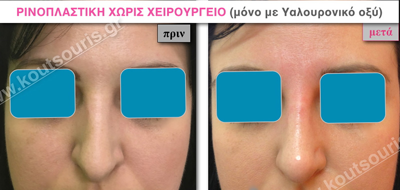 rhinoplasty-with-hyaluronic-acid-01