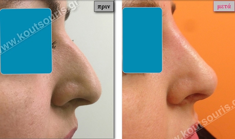 rhinoplasty-with-hyaluronic-acid-02