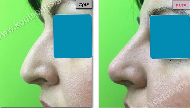 rhinoplasty-with-hyaluronic-acid-03