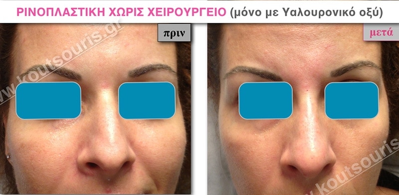 rhinoplasty-with-hyaluronic-acid-04