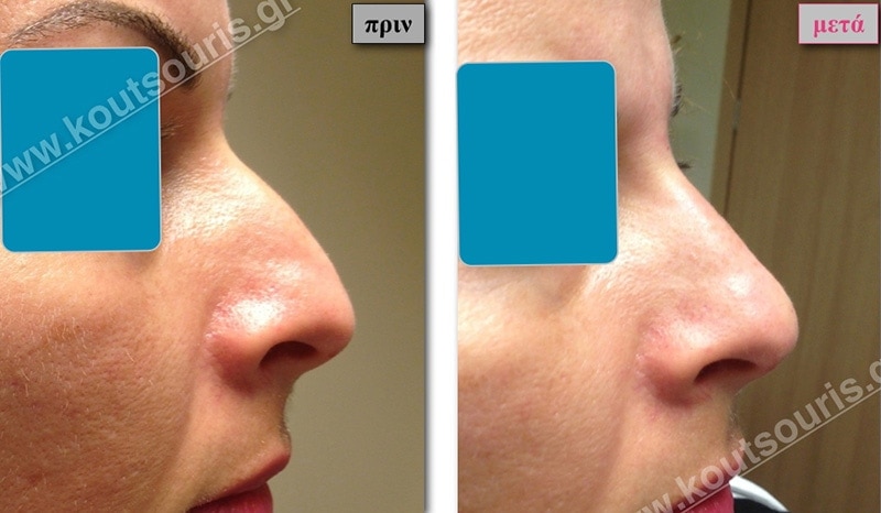 rhinoplasty-with-hyaluronic-acid-05