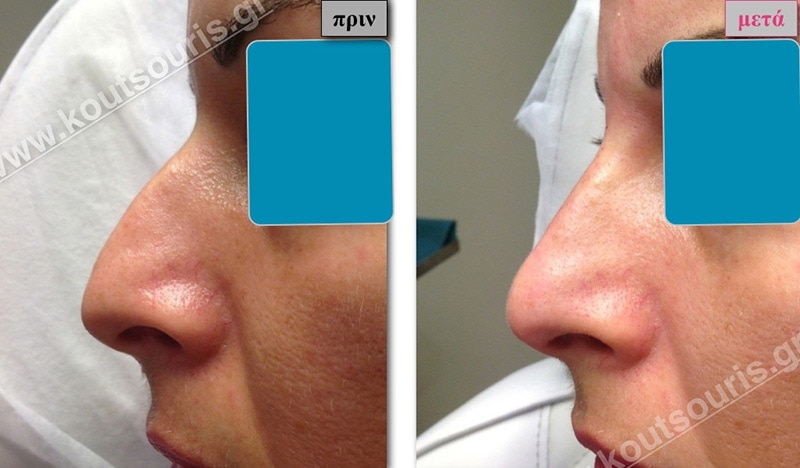 rhinoplasty-with-hyaluronic-acid-06