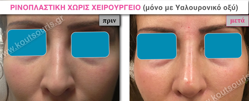 rhinoplasty-with-hyaluronic-acid-07