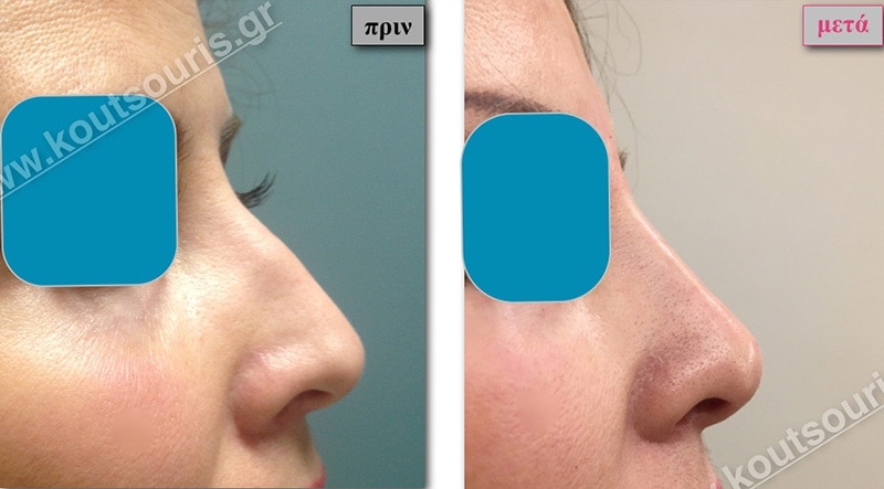 rhinoplasty-with-hyaluronic-acid-08