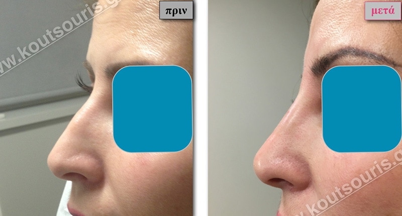 rhinoplasty-with-hyaluronic-acid-09