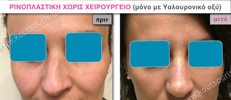 rhinoplasty-with-hyaluronic-acid-10