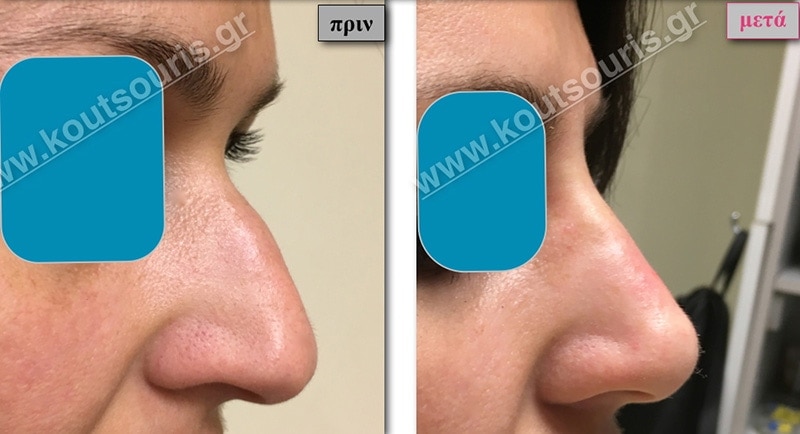 rhinoplasty-with-hyaluronic-acid-11