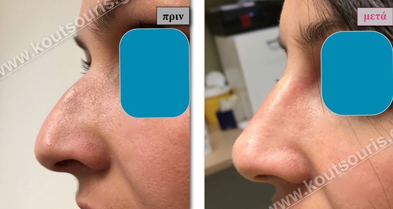 rhinoplasty-with-hyaluronic-acid-12