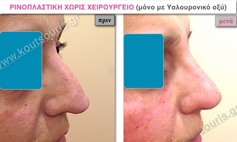 rhinoplasty-with-hyaluronic-acid-13