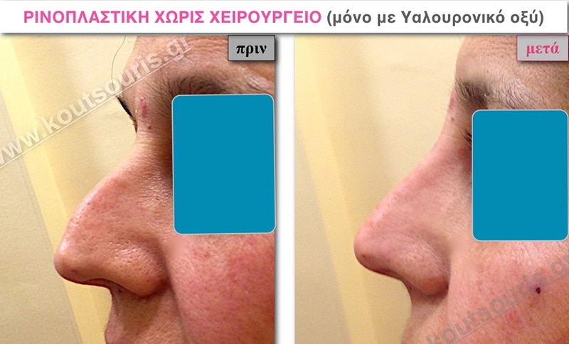 rhinoplasty-with-hyaluronic-acid-14