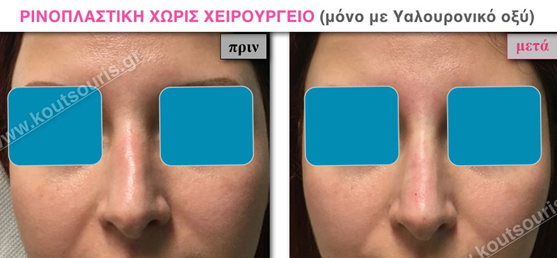 rhinoplasty-with-hyaluronic-acid-15