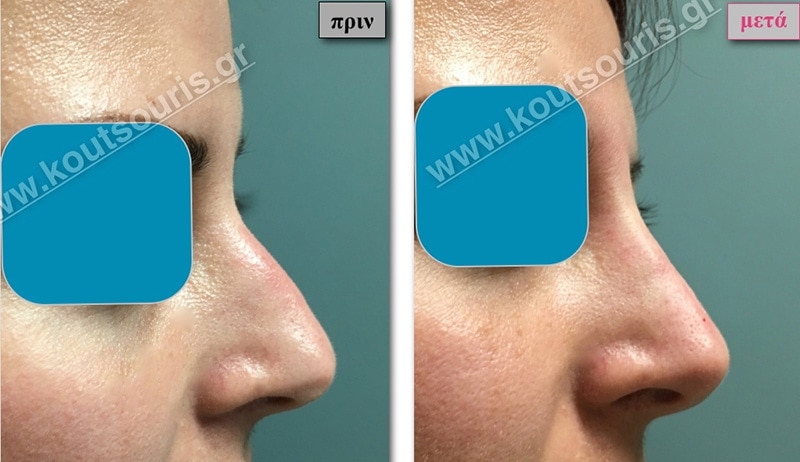 rhinoplasty-with-hyaluronic-acid-16