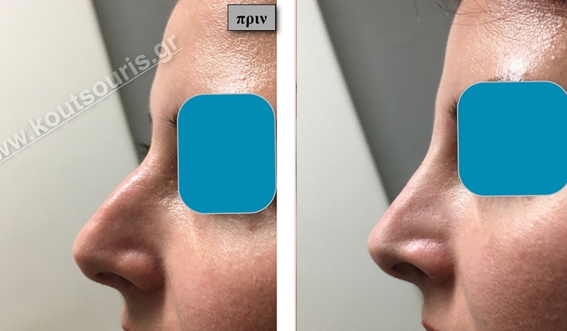 rhinoplasty-with-hyaluronic-acid-17