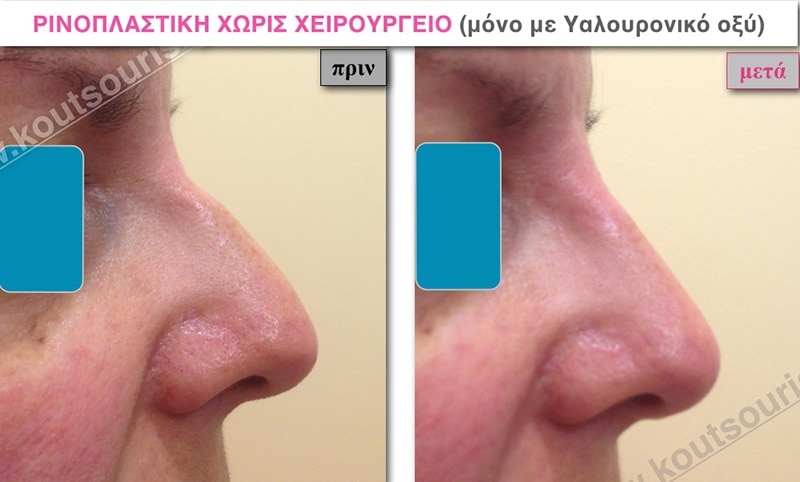 rhinoplasty-with-hyaluronic-acid-18