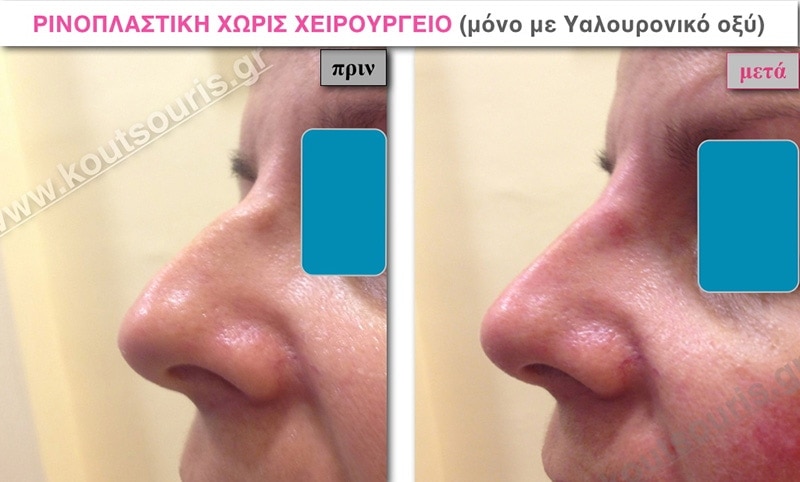 rhinoplasty-with-hyaluronic-acid-19