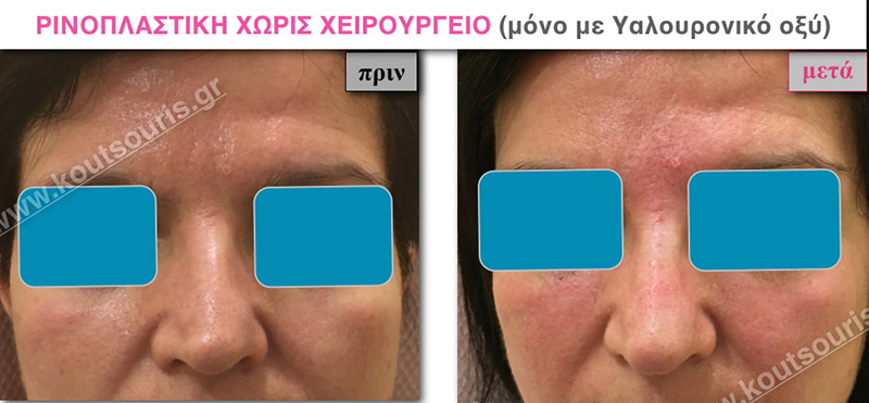 rhinoplasty-with-hyaluronic-acid-20