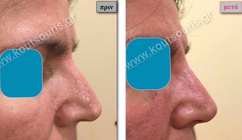 rhinoplasty-with-hyaluronic-acid-21