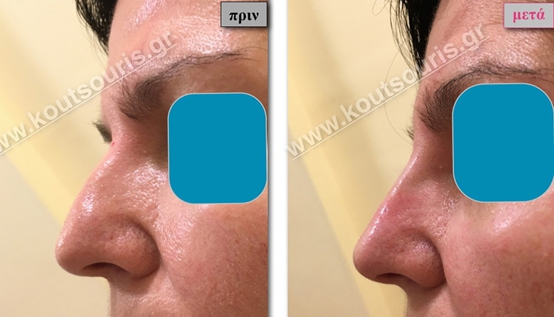 rhinoplasty-with-hyaluronic-acid-22