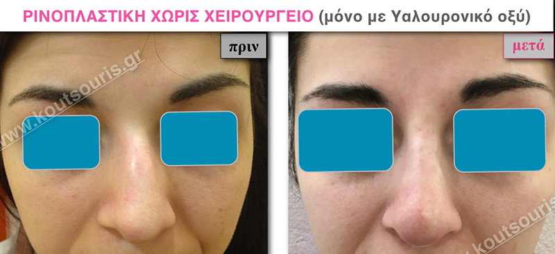 rhinoplasty-with-hyaluronic-acid-23