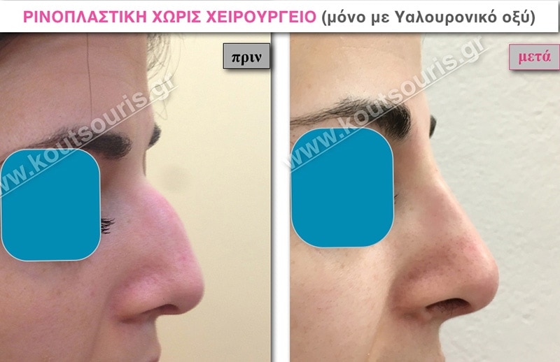 rhinoplasty-with-hyaluronic-acid-24