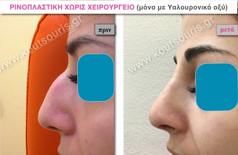 rhinoplasty-with-hyaluronic-acid-25