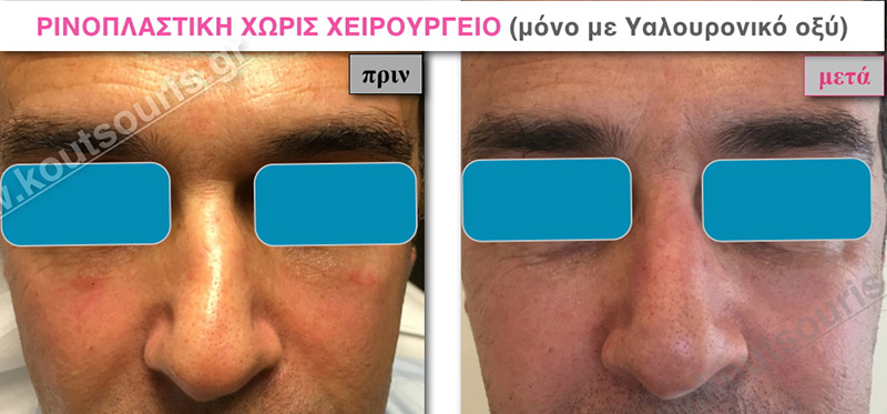 rhinoplasty-with-hyaluronic-acid-26